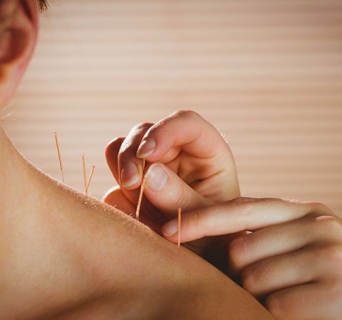 acupuncture-needles3